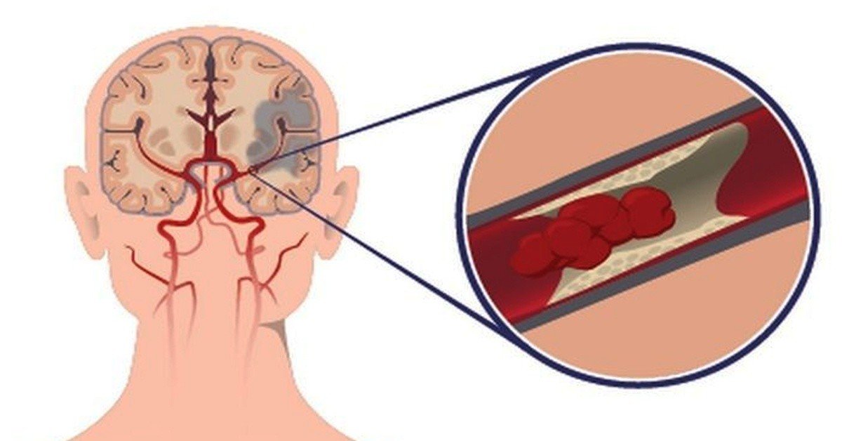 Что такое ишемический инсульт головного мозга. Ишемический инсульт артерии головы. Тромботический инсульт головного мозга.
