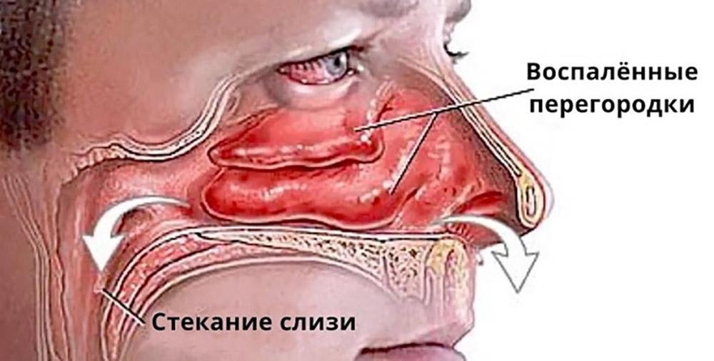 Избавляем детей от соплей. Быстрый способ Мамам на заметку