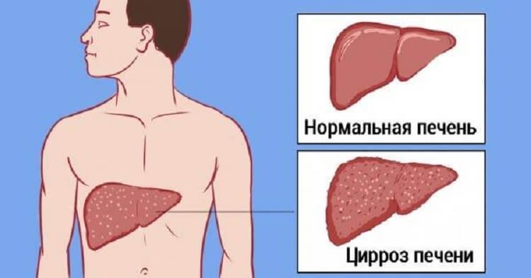 Мы травим свою печень одним привычным продуктом! Настоящая гадость