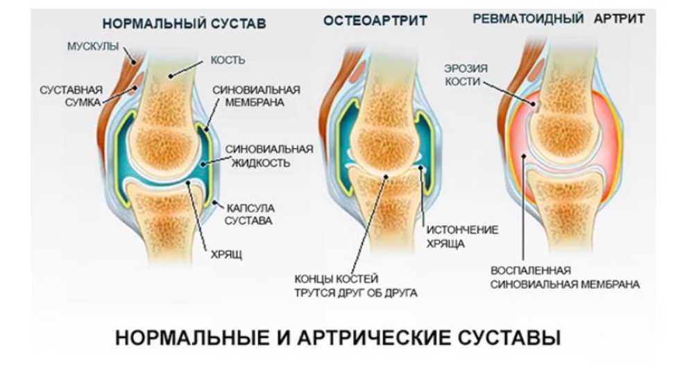 Brote artritis reumatoide